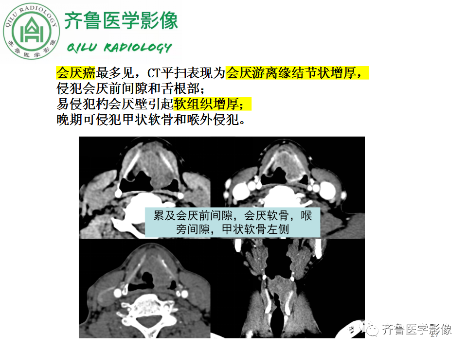 影像PPT - 【PPT】喉癌的定位、诊断及鉴别诊断-26