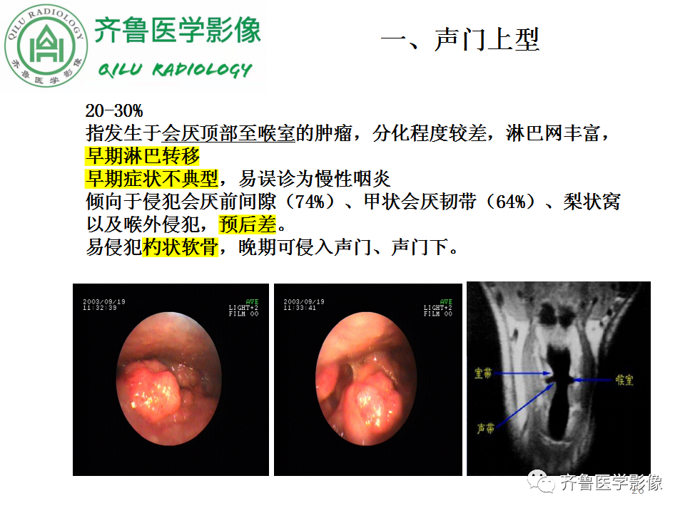 影像PPT - 【PPT】喉癌的定位、诊断及鉴别诊断-25