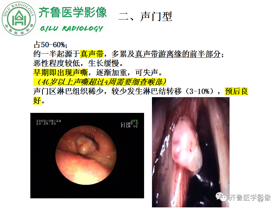 影像PPT - 【PPT】喉癌的定位、诊断及鉴别诊断-27
