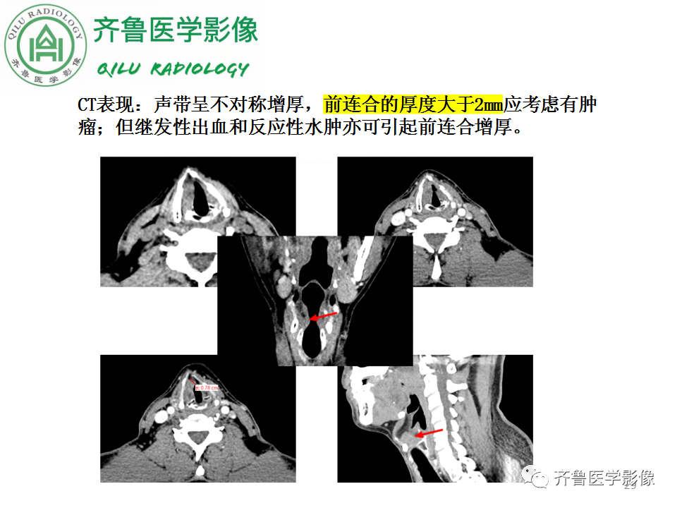 影像PPT - 【PPT】喉癌的定位、诊断及鉴别诊断-28