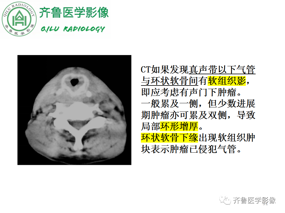 影像PPT - 【PPT】喉癌的定位、诊断及鉴别诊断-30