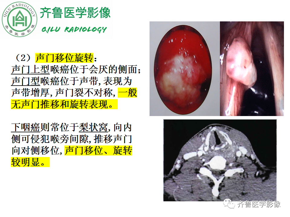 影像PPT - 【PPT】喉癌的定位、诊断及鉴别诊断-33