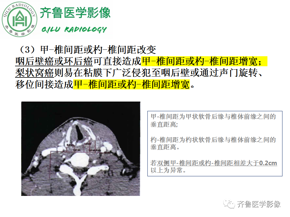 影像PPT - 【PPT】喉癌的定位、诊断及鉴别诊断-34