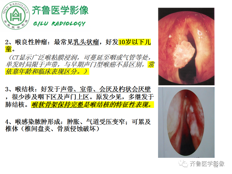 影像PPT - 【PPT】喉癌的定位、诊断及鉴别诊断-36