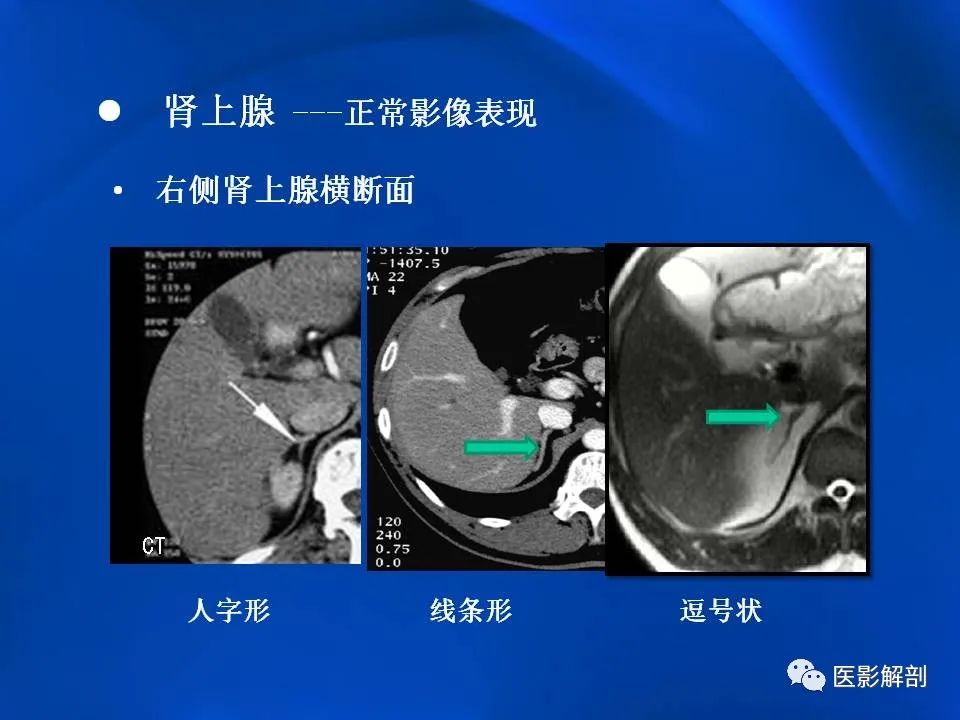 影像PPT - 【PPT】肾上腺解剖及相关病变的影像诊断-10