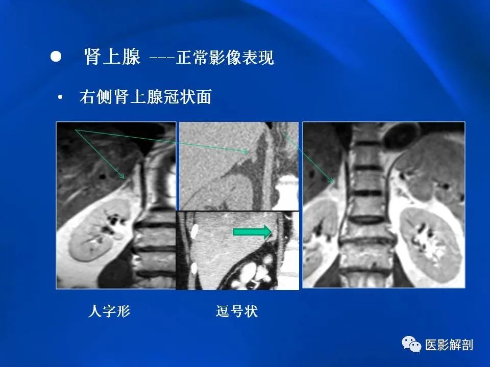 影像PPT - 【PPT】肾上腺解剖及相关病变的影像诊断-11