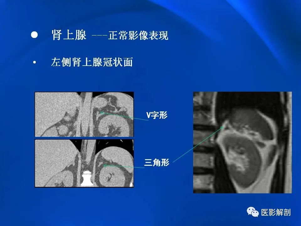 影像PPT - 【PPT】肾上腺解剖及相关病变的影像诊断-13