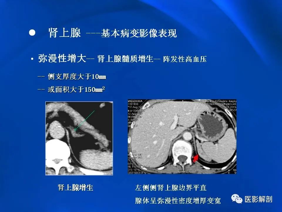 影像PPT - 【PPT】肾上腺解剖及相关病变的影像诊断-15