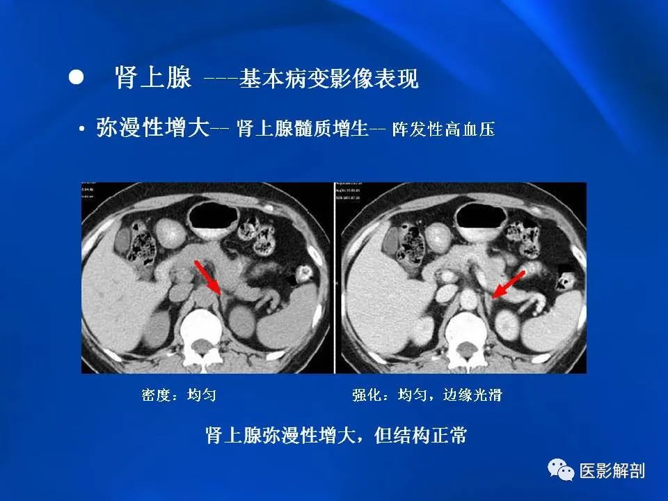 影像PPT - 【PPT】肾上腺解剖及相关病变的影像诊断-17