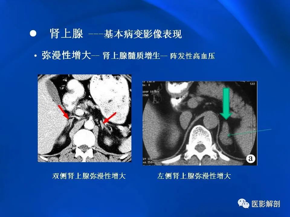 影像PPT - 【PPT】肾上腺解剖及相关病变的影像诊断-16