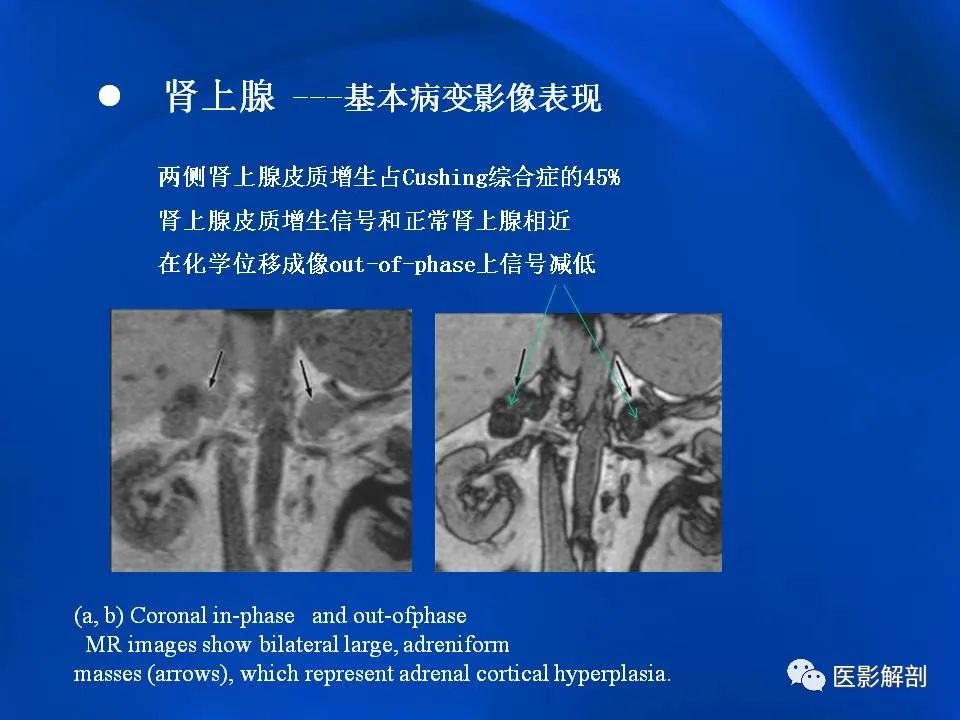 影像PPT - 【PPT】肾上腺解剖及相关病变的影像诊断-19