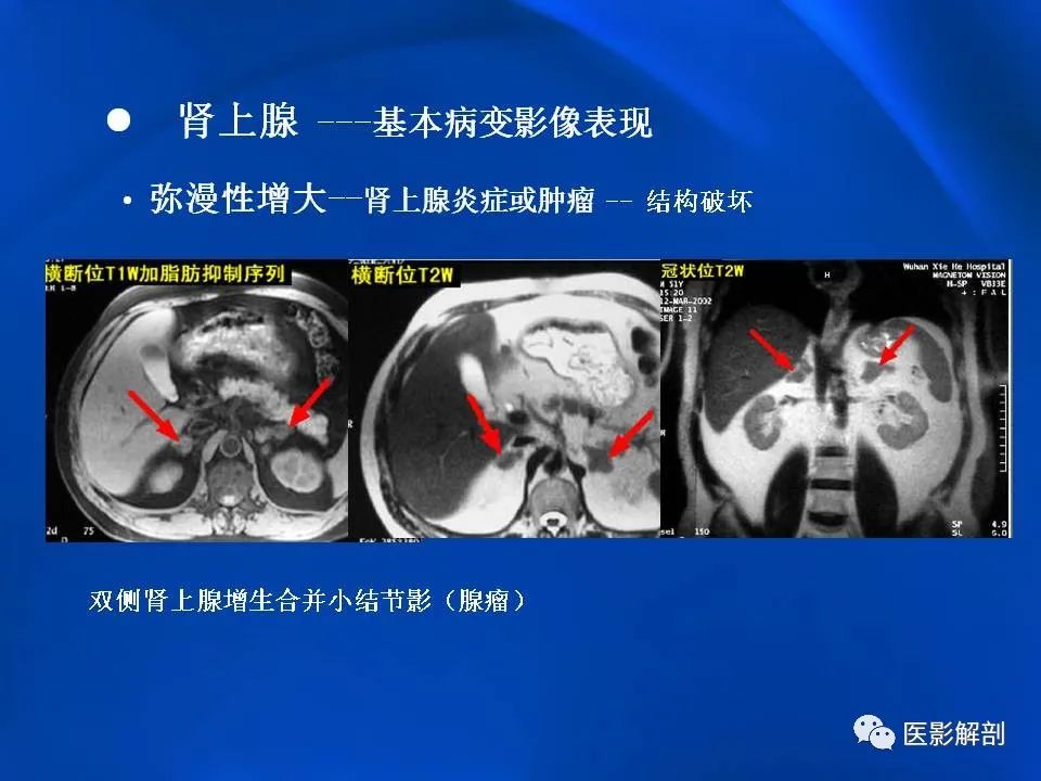 影像PPT - 【PPT】肾上腺解剖及相关病变的影像诊断-18