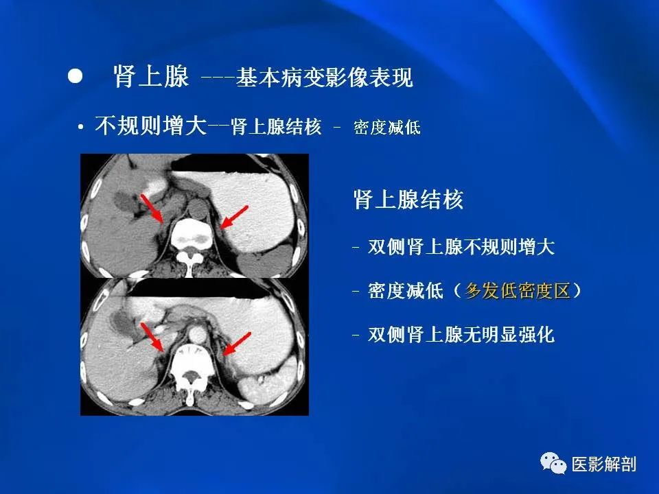 影像PPT - 【PPT】肾上腺解剖及相关病变的影像诊断-21