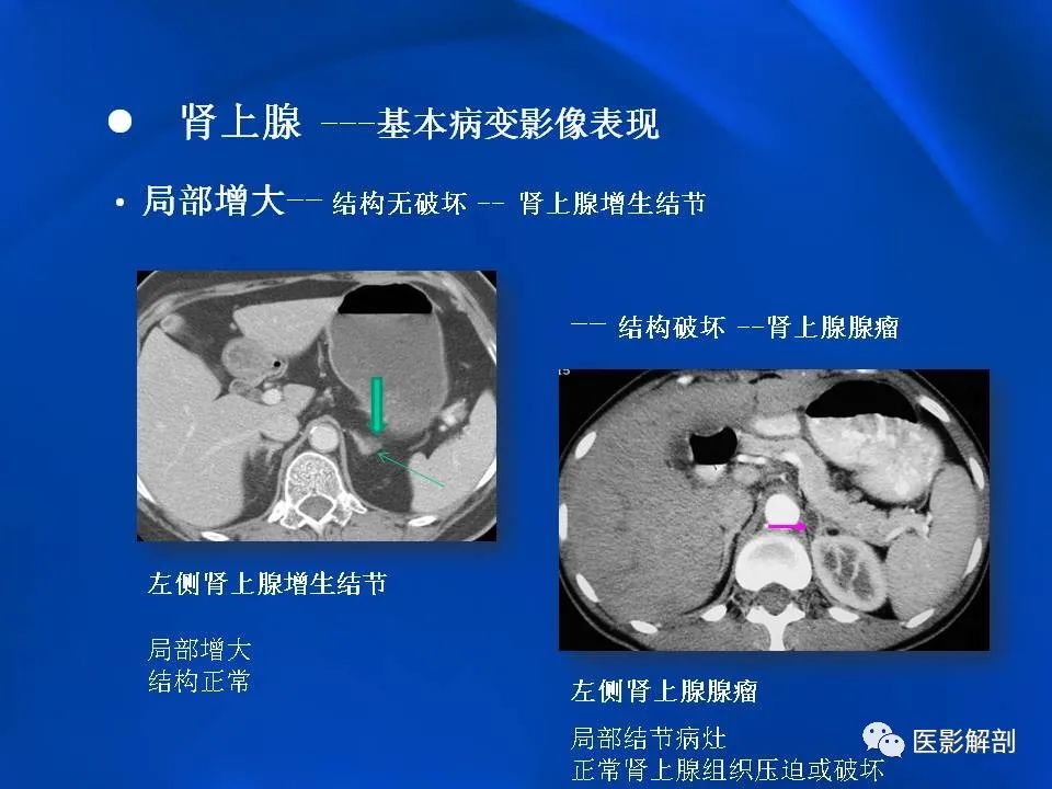 影像PPT - 【PPT】肾上腺解剖及相关病变的影像诊断-20