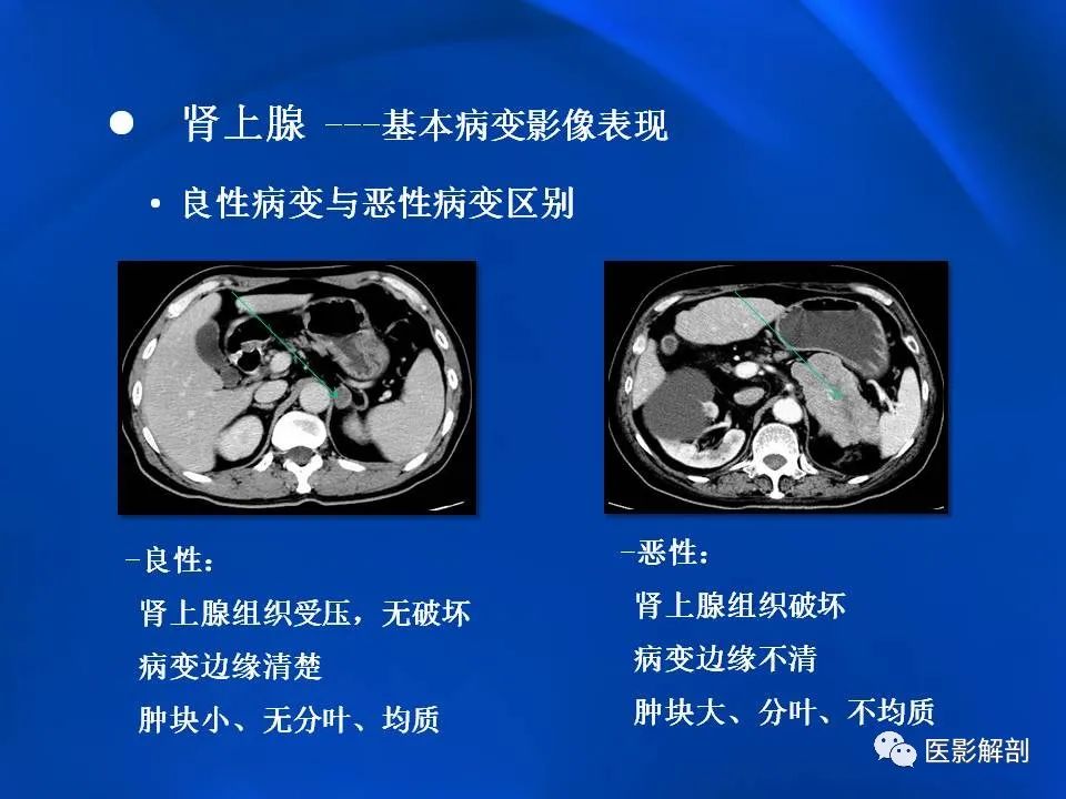 影像PPT - 【PPT】肾上腺解剖及相关病变的影像诊断-25