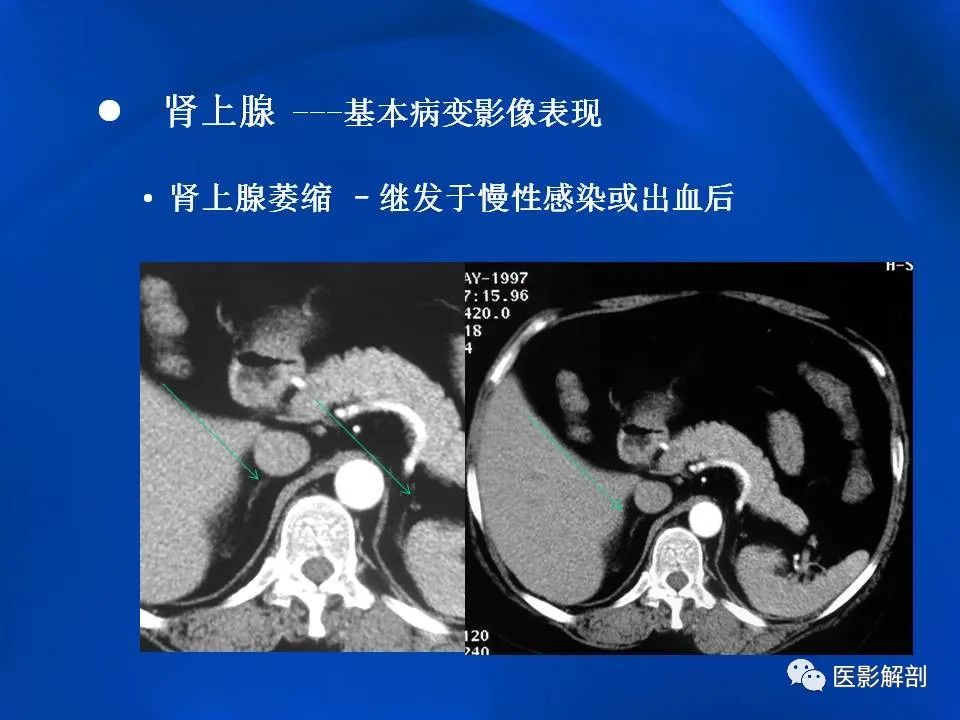 影像PPT - 【PPT】肾上腺解剖及相关病变的影像诊断-22