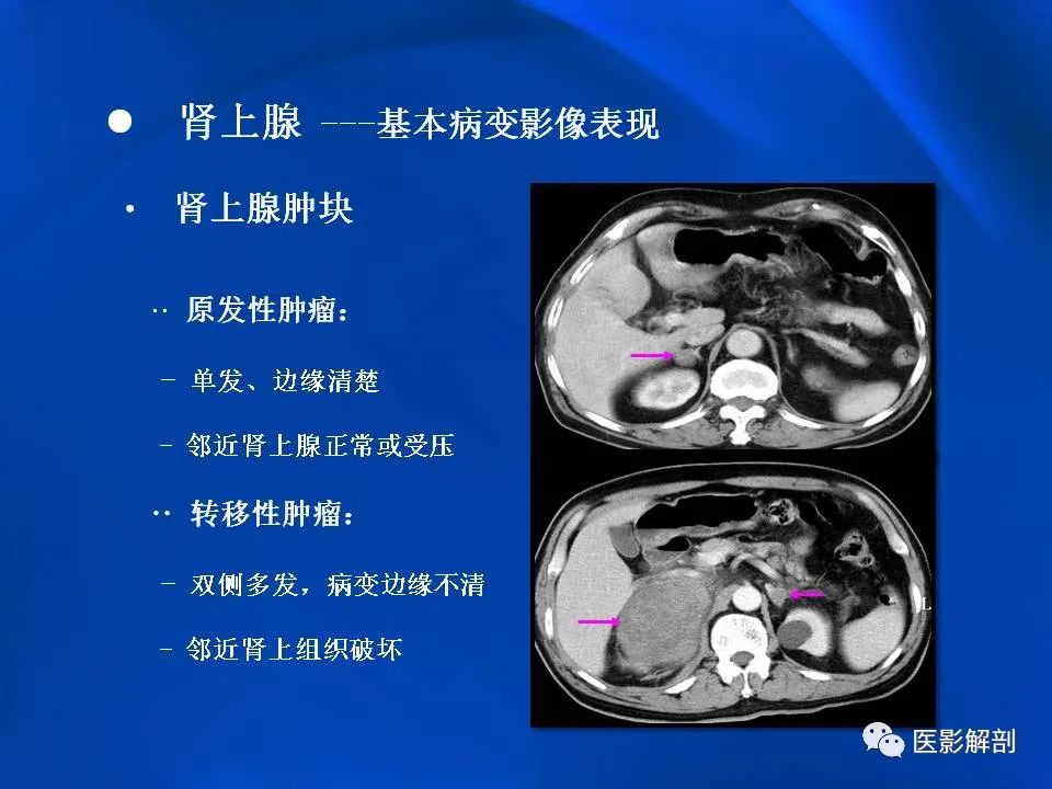 影像PPT - 【PPT】肾上腺解剖及相关病变的影像诊断-23
