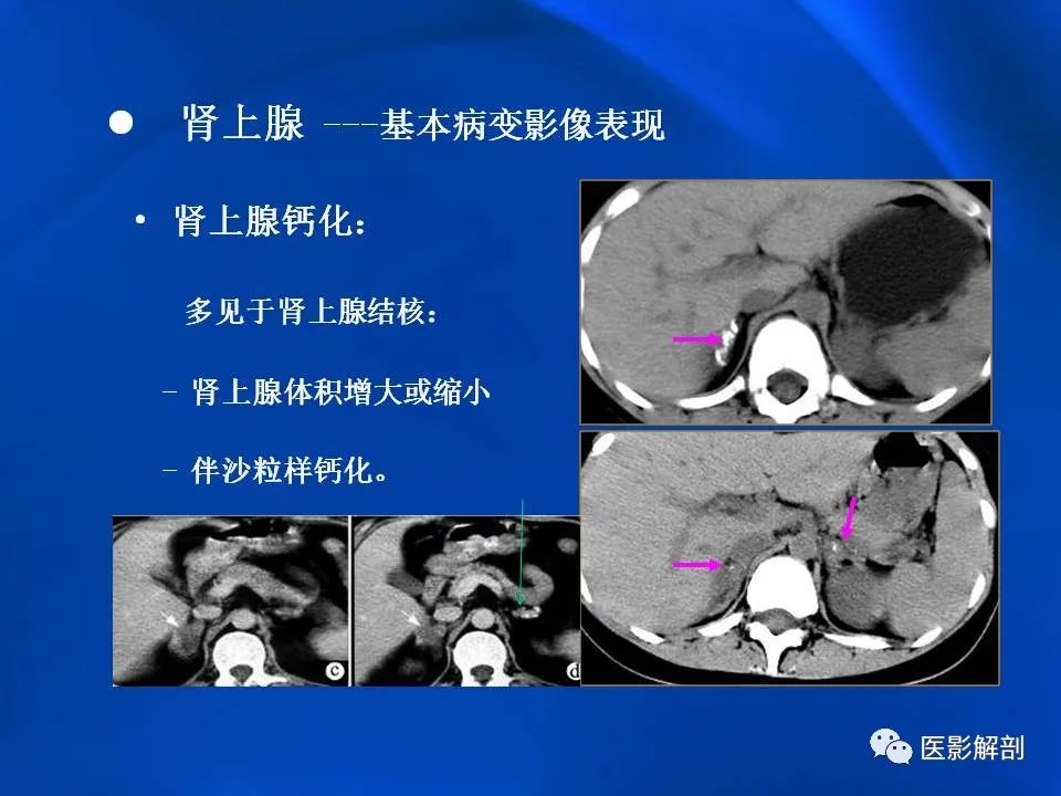 影像PPT - 【PPT】肾上腺解剖及相关病变的影像诊断-24