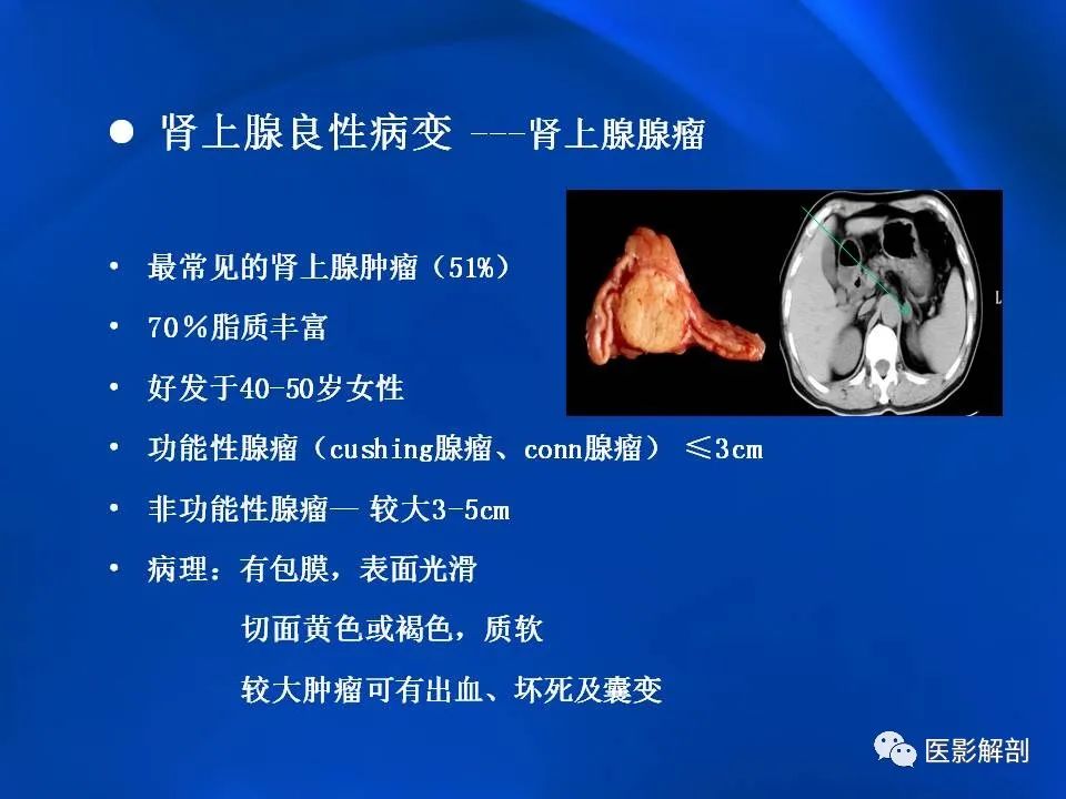 影像PPT - 【PPT】肾上腺解剖及相关病变的影像诊断-27