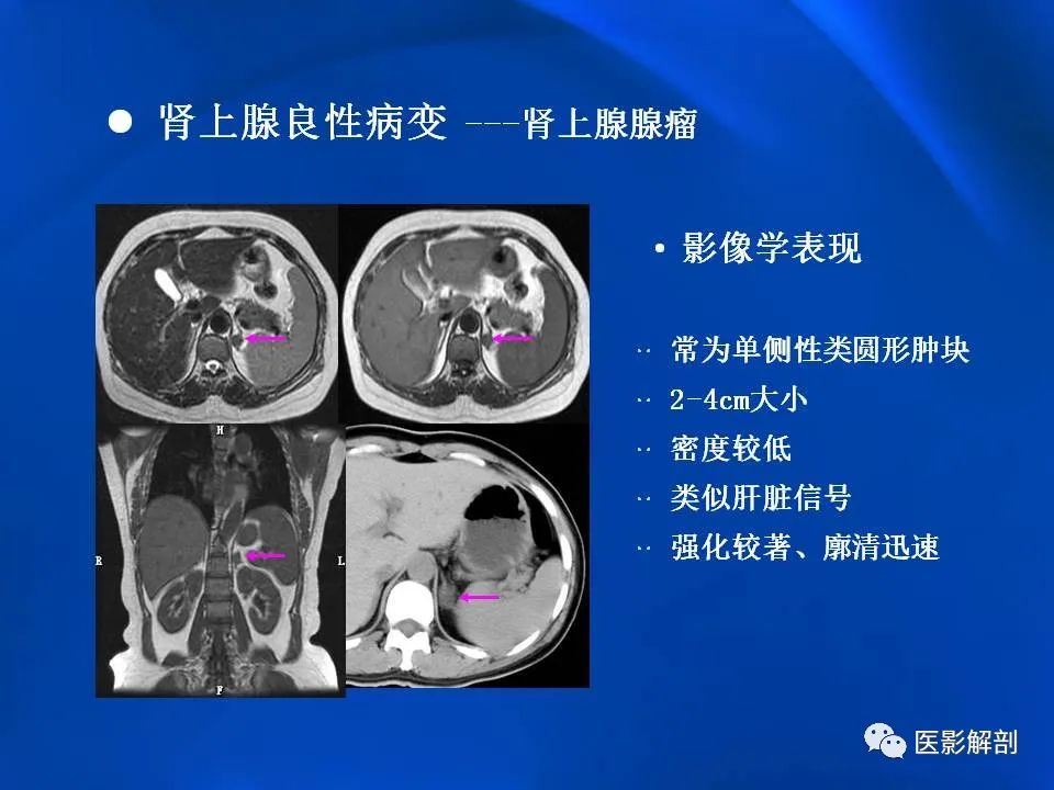 影像PPT - 【PPT】肾上腺解剖及相关病变的影像诊断-28