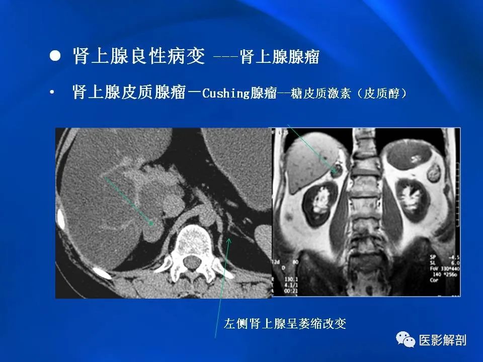影像PPT - 【PPT】肾上腺解剖及相关病变的影像诊断-31