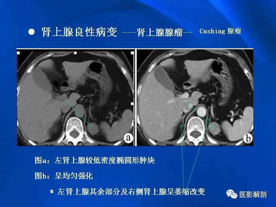 影像PPT - 【PPT】肾上腺解剖及相关病变的影像诊断-30