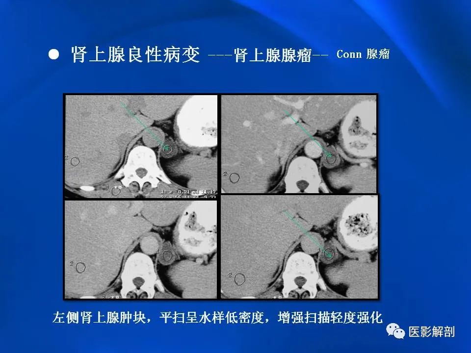 影像PPT - 【PPT】肾上腺解剖及相关病变的影像诊断-32