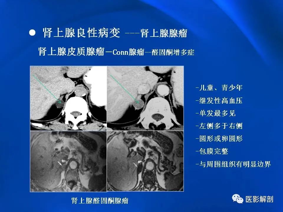 影像PPT - 【PPT】肾上腺解剖及相关病变的影像诊断-33