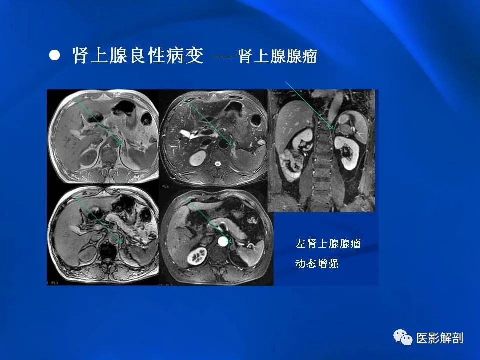 影像PPT - 【PPT】肾上腺解剖及相关病变的影像诊断-34