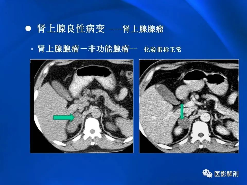 影像PPT - 【PPT】肾上腺解剖及相关病变的影像诊断-37