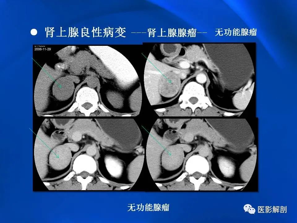 影像PPT - 【PPT】肾上腺解剖及相关病变的影像诊断-36