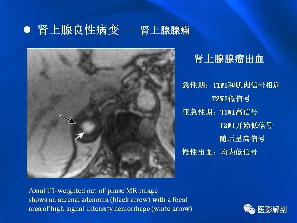 影像PPT - 【PPT】肾上腺解剖及相关病变的影像诊断-35