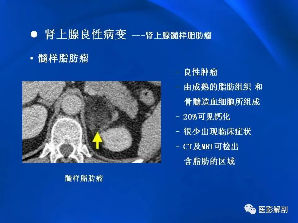 影像PPT - 【PPT】肾上腺解剖及相关病变的影像诊断-38