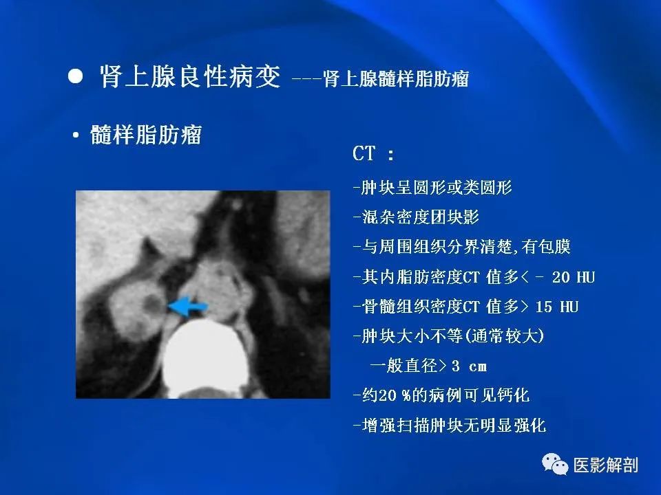 影像PPT - 【PPT】肾上腺解剖及相关病变的影像诊断-39