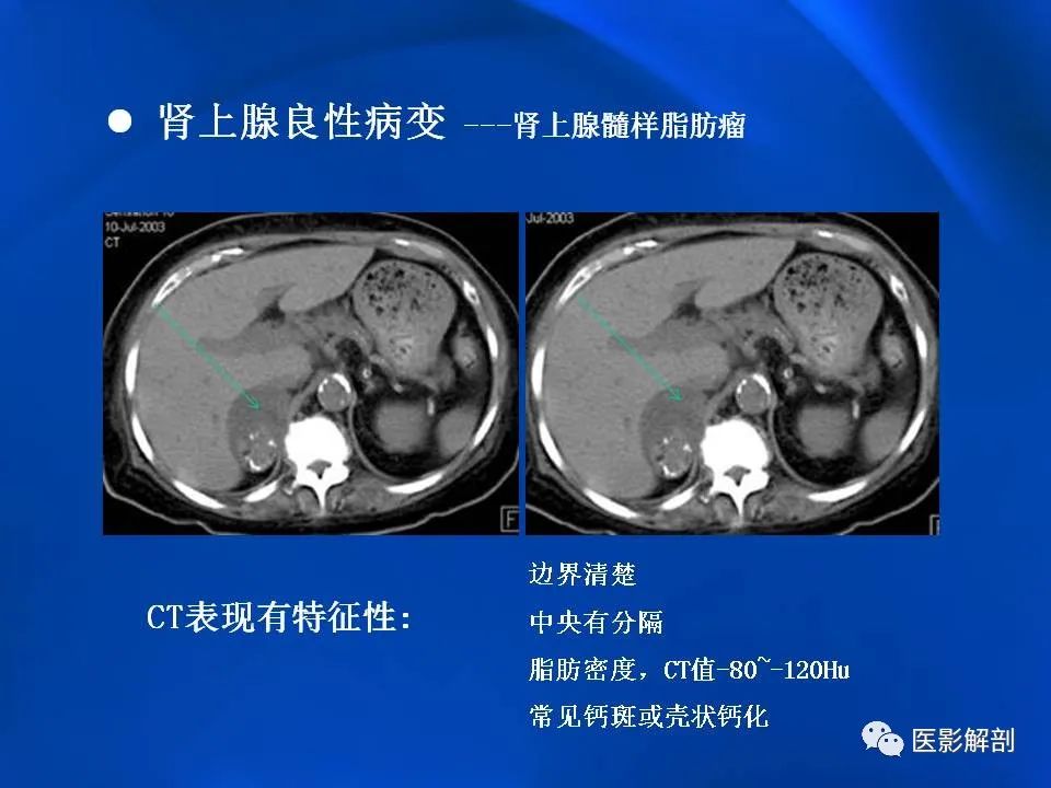 影像PPT - 【PPT】肾上腺解剖及相关病变的影像诊断-40
