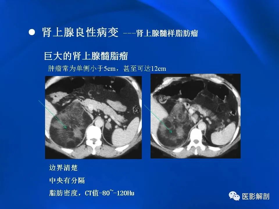 影像PPT - 【PPT】肾上腺解剖及相关病变的影像诊断-42