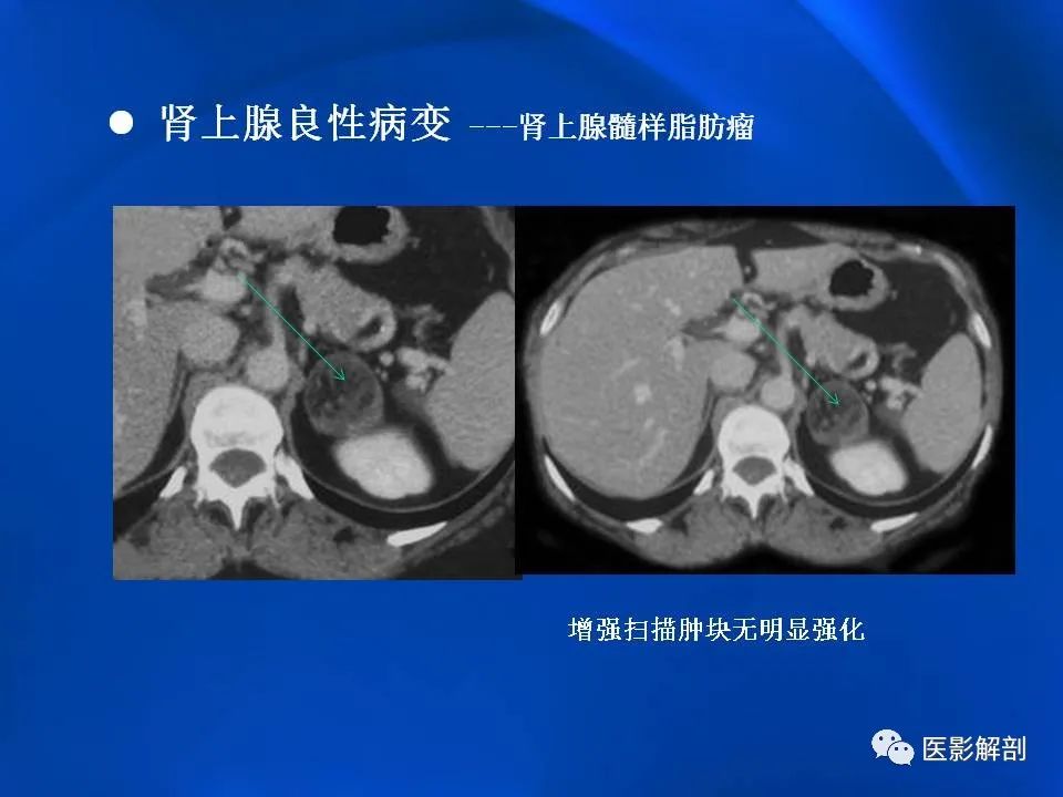 影像PPT - 【PPT】肾上腺解剖及相关病变的影像诊断-41