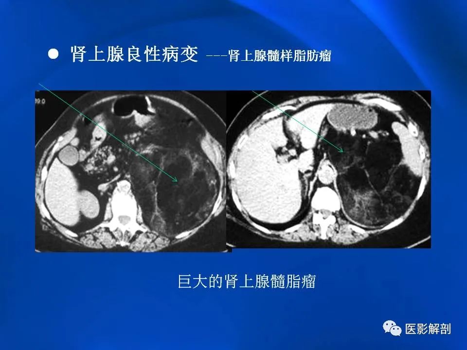 影像PPT - 【PPT】肾上腺解剖及相关病变的影像诊断-43