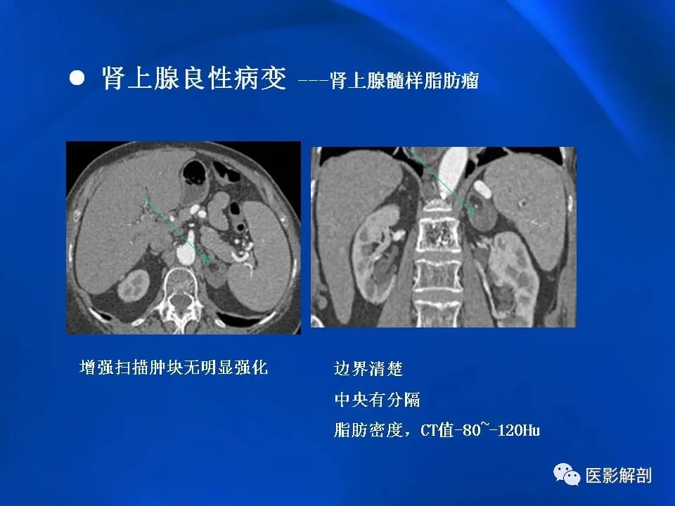 影像PPT - 【PPT】肾上腺解剖及相关病变的影像诊断-44
