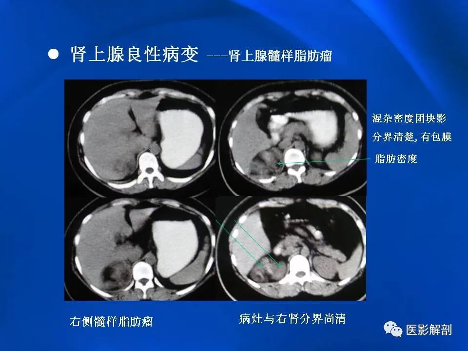 影像PPT - 【PPT】肾上腺解剖及相关病变的影像诊断-45