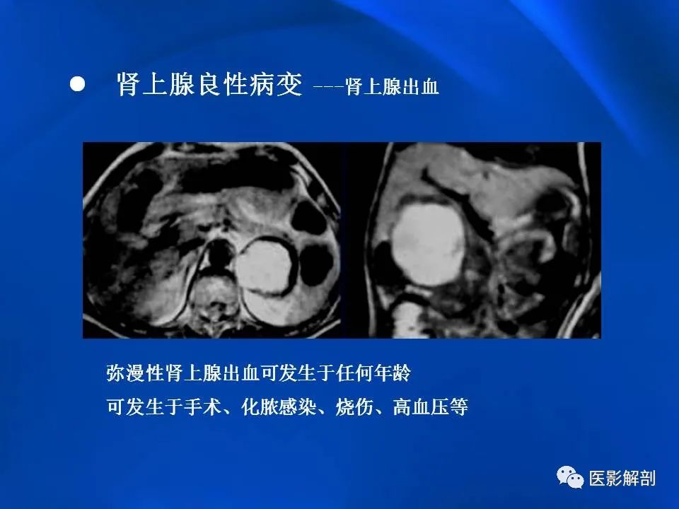影像PPT - 【PPT】肾上腺解剖及相关病变的影像诊断-47
