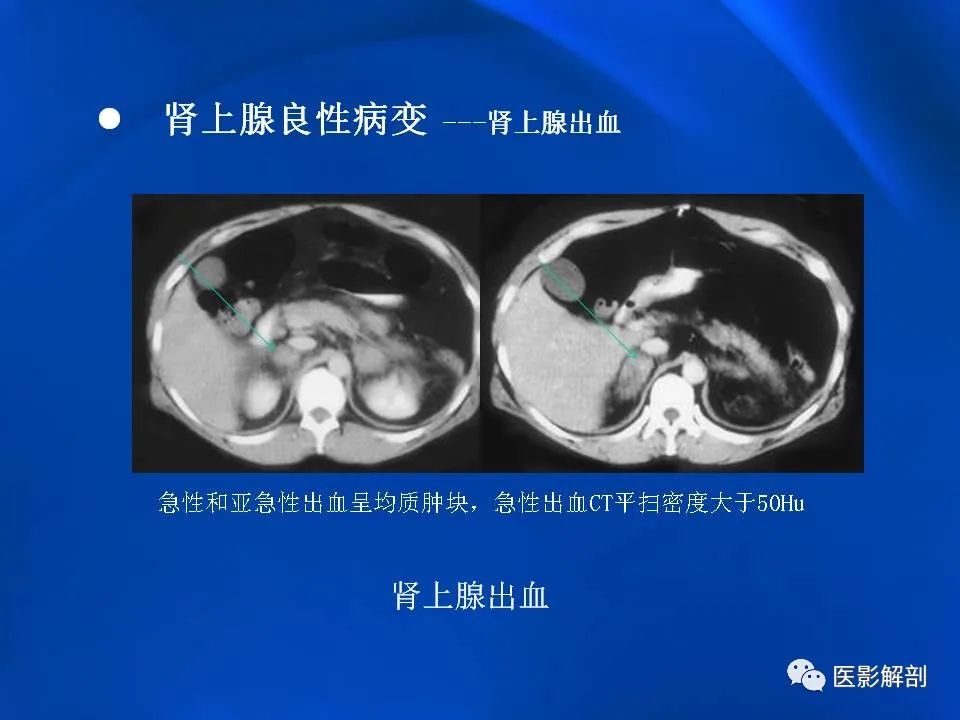 影像PPT - 【PPT】肾上腺解剖及相关病变的影像诊断-49