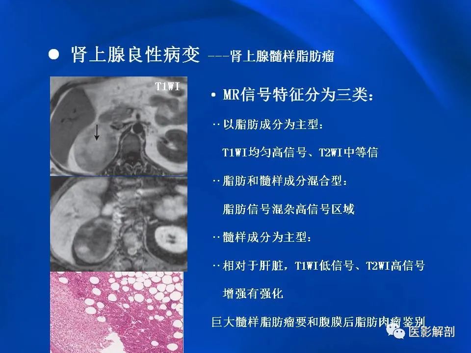 影像PPT - 【PPT】肾上腺解剖及相关病变的影像诊断-46