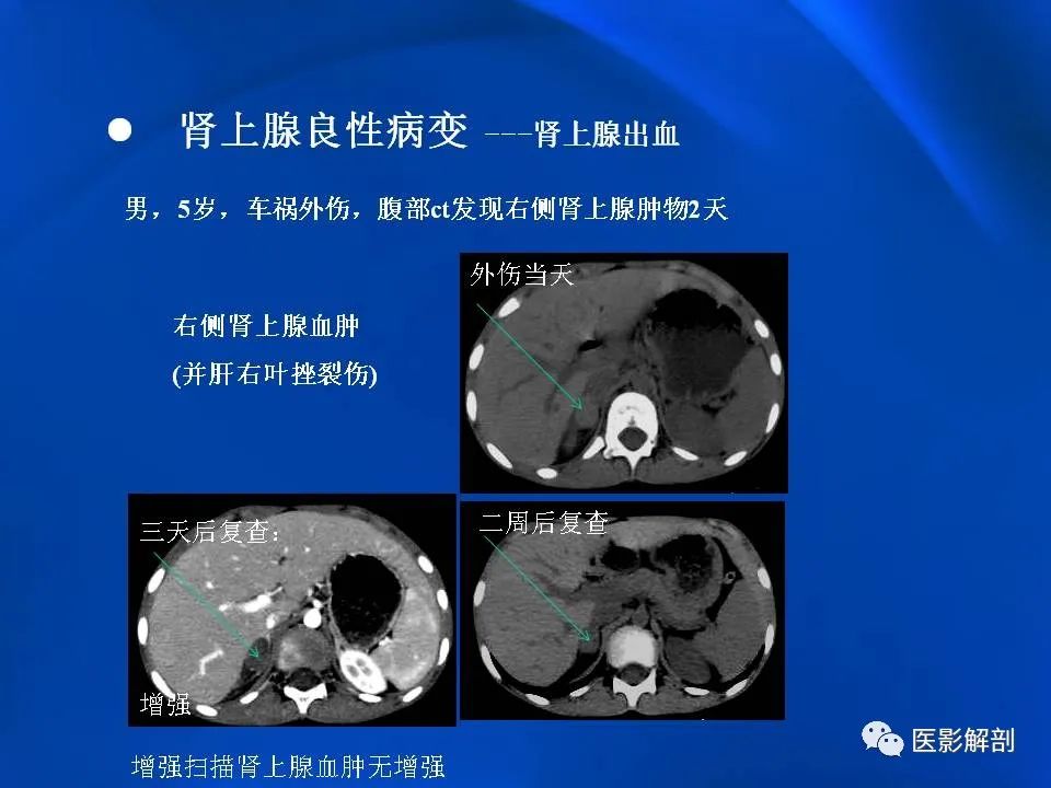影像PPT - 【PPT】肾上腺解剖及相关病变的影像诊断-48
