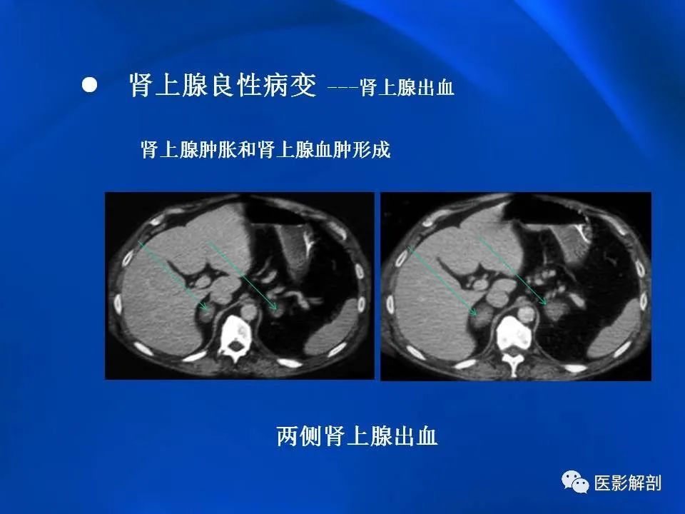 影像PPT - 【PPT】肾上腺解剖及相关病变的影像诊断-50