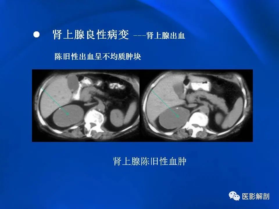 影像PPT - 【PPT】肾上腺解剖及相关病变的影像诊断-53