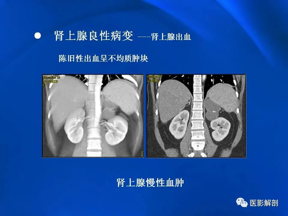 影像PPT - 【PPT】肾上腺解剖及相关病变的影像诊断-54