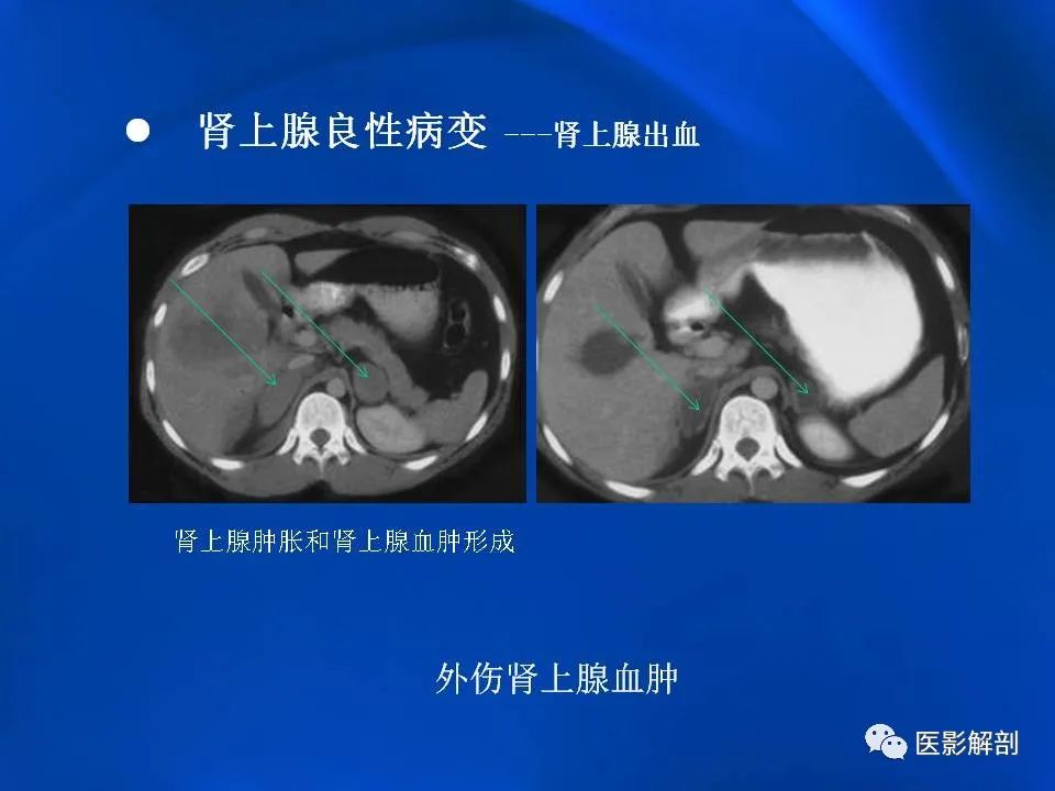 影像PPT - 【PPT】肾上腺解剖及相关病变的影像诊断-51