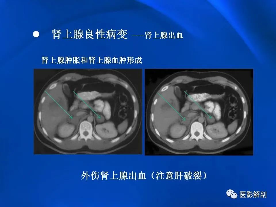 影像PPT - 【PPT】肾上腺解剖及相关病变的影像诊断-52