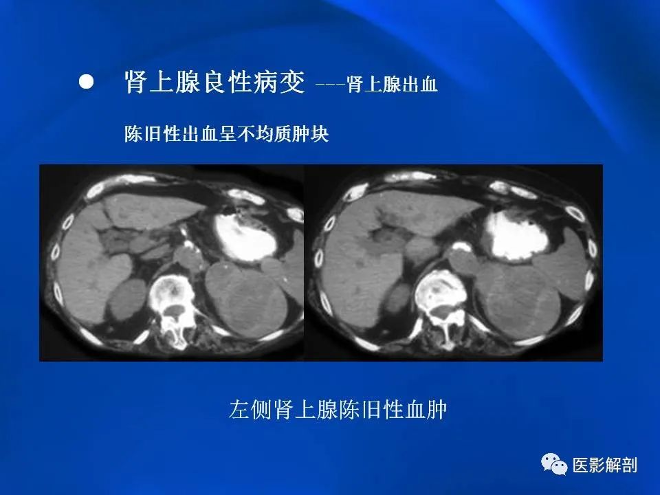 影像PPT - 【PPT】肾上腺解剖及相关病变的影像诊断-55